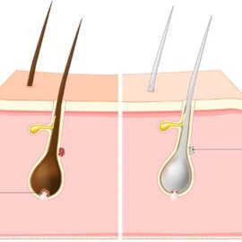 Medication-Induced Repigmentation of Gray Hair: A Systematic Review Medication-Induced Repigmentation of Gray Hair: A Systematic Review