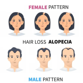 What is Alopecia and does it affect me